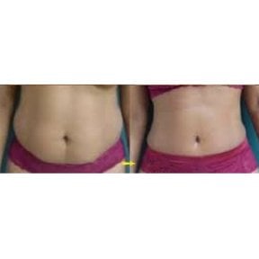 Before and after liposuction results at Odontoliuzzi Dentistry and Health, abdomen contouring
