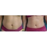 Before and after liposuction results at Odontoliuzzi Dentistry and Health, abdomen contouring