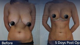 Before and after breast implants with lift results at Dr. Safa Manav Clinic, improved contour