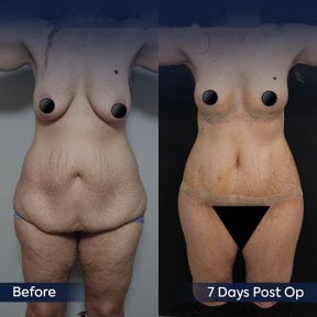 Before and after breast implants with breast lift at Dr. Safa Manav Clinic, visible contour result