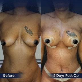 Before and after breast implants with lift at Dr. Safa Manav Clinic, 5 days post-op result