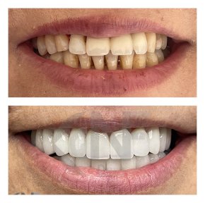 Resultados de antes y después de smile makeover en Nifa Dent International, transformación con carillas