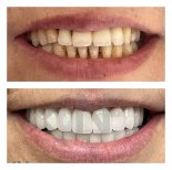 Resultados de antes y después de smile makeover en Nifa Dent International, transformación con carillas