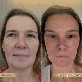 Vorher-nachher-Ergebnis Halsstraffung bei Dr. Safa Manav Clinic, sichtbare Hautstraffung