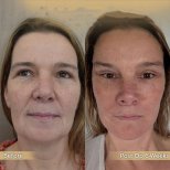 Vorher-nachher-Ergebnis Halsstraffung bei Dr. Safa Manav Clinic, sichtbare Hautstraffung
