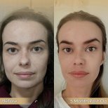 Brauenlifting Vorher-Nachher-Ergebnis in der Dr. Safa Manav Klinik, 5 Monate postoperativ