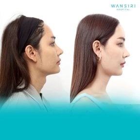 Before and after tracheal shave results at Wansiri Hospital, visible neck contour improvement