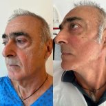 Facelift before and after results at VM Medical Park Florya Hospital, visible facial rejuvenation