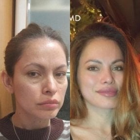 Facelift before and after results at VM Medical Park Florya Hospital, facial rejuvenation outcome