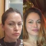 Facelift before and after results at VM Medical Park Florya Hospital, facial rejuvenation outcome