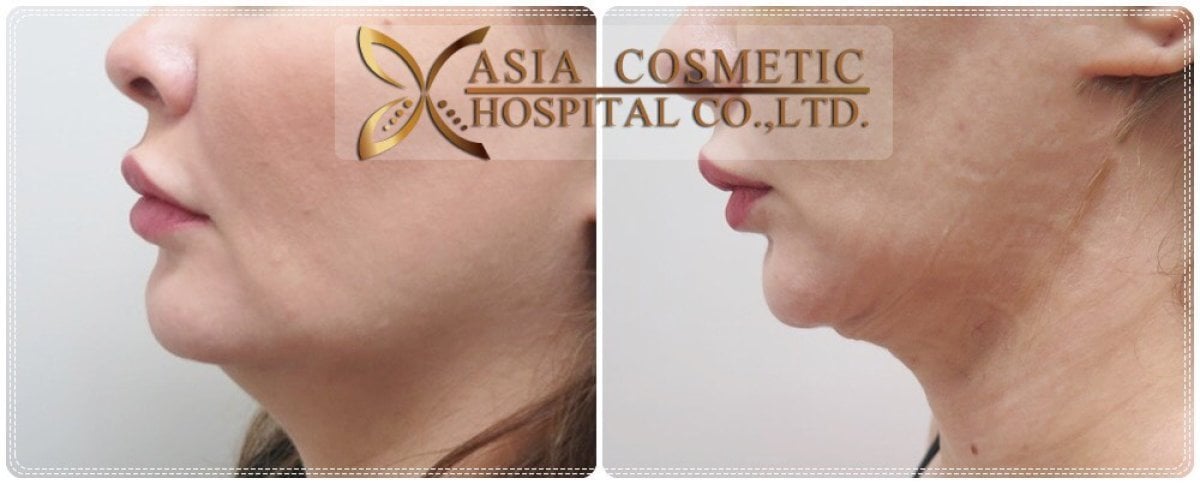 نتائج شفط دهون الذقن قبل وبعد في Asia Cosmetic Hospital، تحسين تحديد الفك