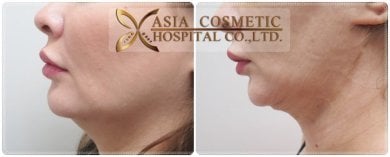 Vorher-nachher-Ergebnisse Kinn-Liposuktion bei Asia Cosmetic Hospital, verbesserte Kontur