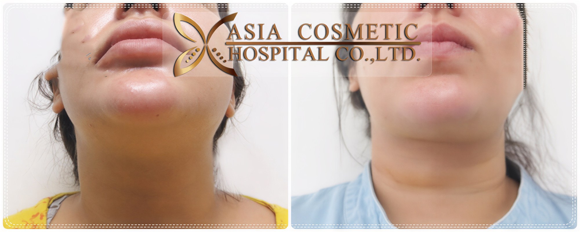نتائج شفط دهون الذقن قبل وبعد في Asia Cosmetic Hospital، تحسين تحديد الفك
