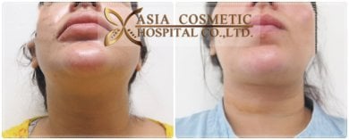 Vorher-nachher-Ergebnis Kinn-Liposuktion bei Asia Cosmetic Hospital, verbesserte Kontur