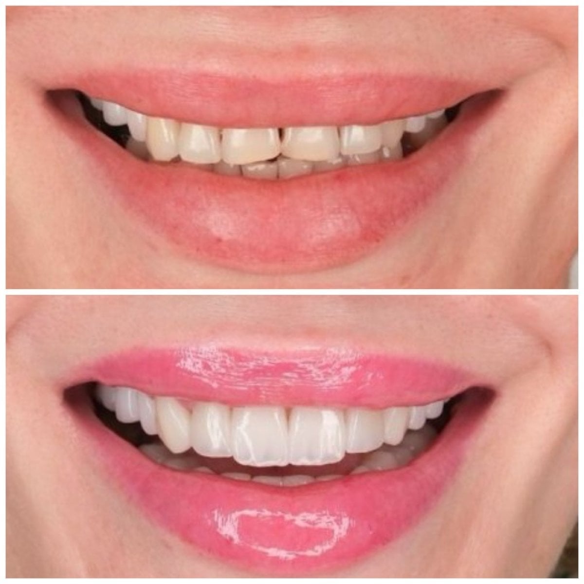Antes y después de carillas de zirconio en YEG Clinic, transformación natural de la sonrisa