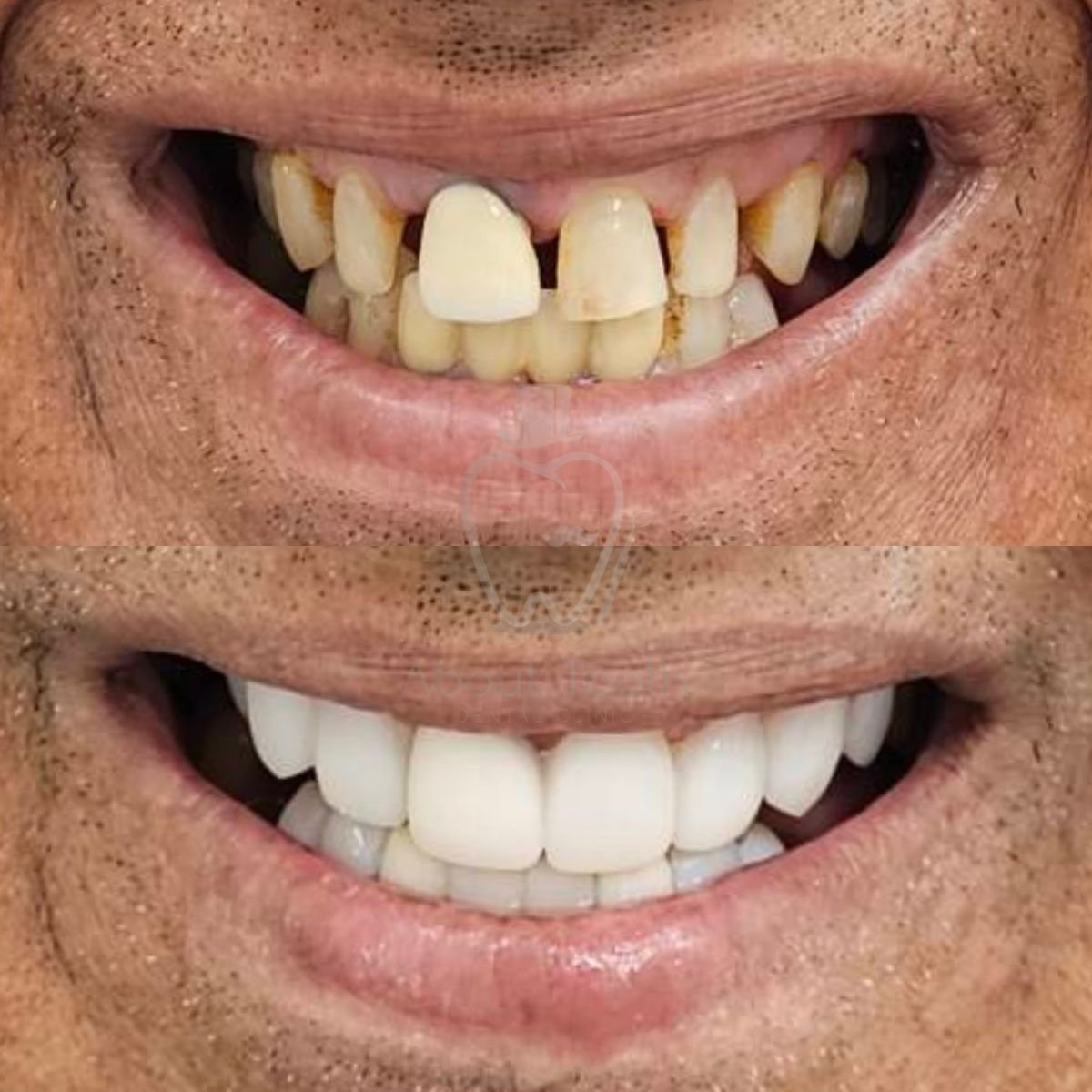 Результаты до и после Hollywood Smile в About Tooth Dental Clinic, преображение улыбки