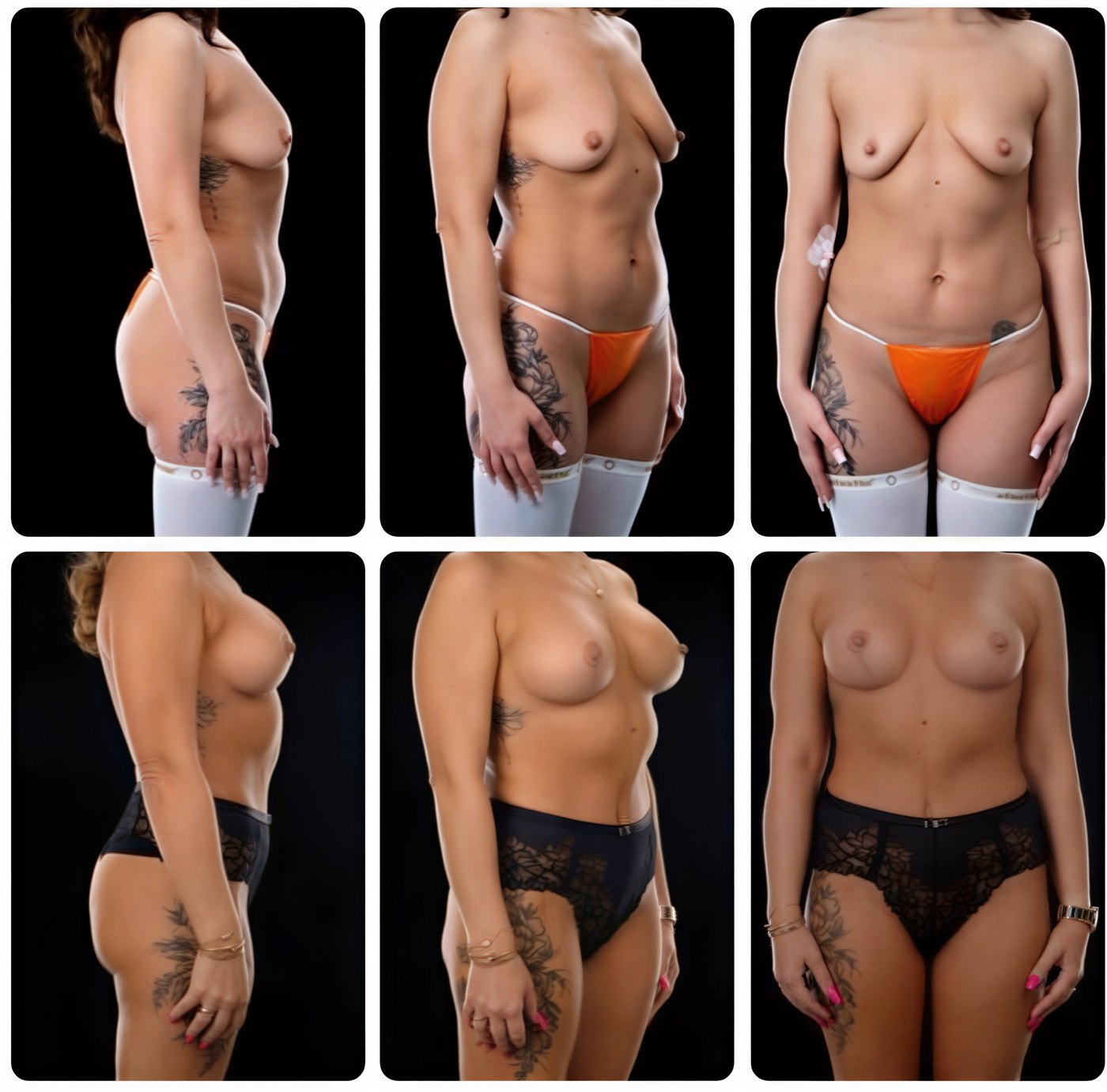 نتائج قبل وبعد عملية مامي ميك أوفر في Yurchenko Plastic Surgery Team، تنسيق الجسم