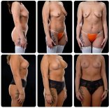 Before and after mommy makeover results at Yurchenko Plastic Surgery Team, body contouring
