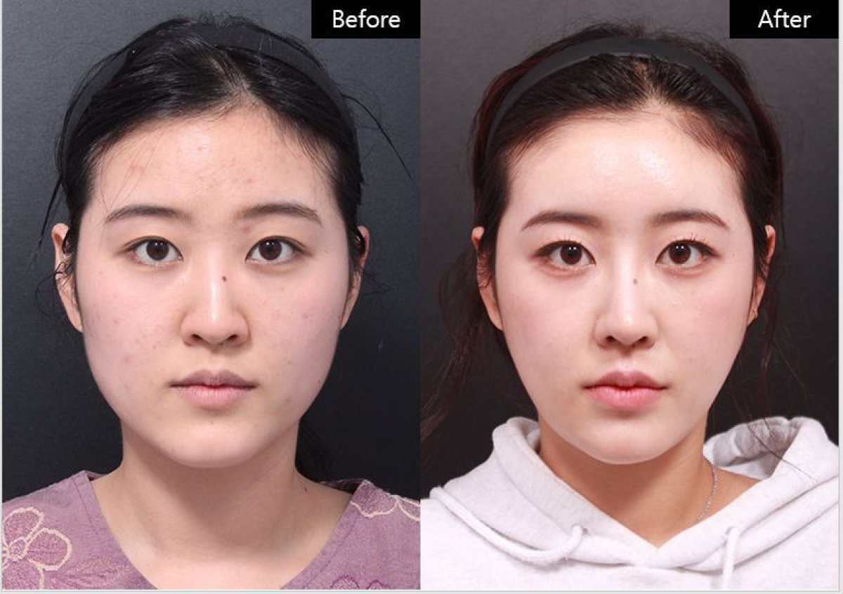 نتائج تجميل الأنف بالفيلر قبل وبعد في VG Plastic Surgery، تحسين شكل الأنف