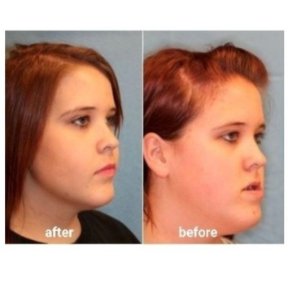 Before and after chin liposuction results at ID Clinic Bangkok, improved jawline contour