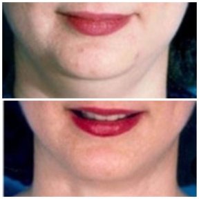 Before and after chin liposuction results at ID Clinic Bangkok, improved jawline contour