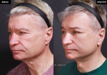 Vorher-nachher-Ergebnis Facelift bei VG Plastic Surgery – sichtbare Verjüngung beim Mann