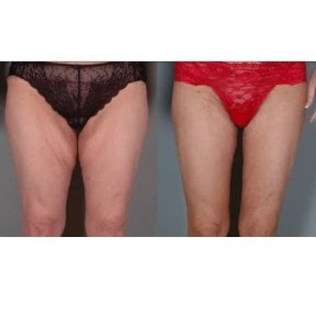 Before and after thigh lift results at ID Clinic Bangkok, improved thigh contour and firmness