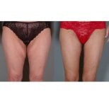 Before and after thigh lift results at ID Clinic Bangkok, improved thigh contour and firmness
