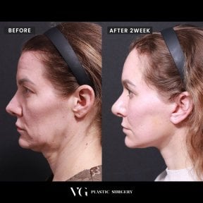 Before and after mini facelift results at VG Plastic Surgery, visible facial contour improvement