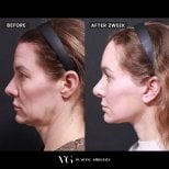 Before and after mini facelift results at VG Plastic Surgery, visible facial contour improvement