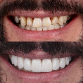 Résultat avant/après facettes Hollywood Smile à SmileBox Dental Clinic - Thonglor