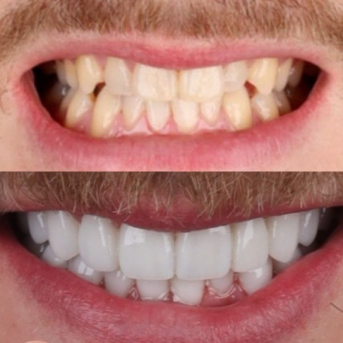 Результаты до и после Hollywood Smile в SmileBox Dental Clinic - Thonglor, Sukhumvit Branch