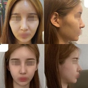 Результаты ринопластики до и после в VG Plastic Surgery, коррекция носа для гармонии лица