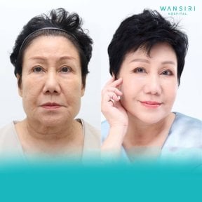 Before and after mini facelift results at Wansiri Hospital, facial rejuvenation procedure