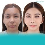 Before and after mini facelift results at Wansiri Hospital, facial rejuvenation procedure