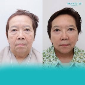 Before and after mini facelift results at Wansiri Hospital, facial rejuvenation procedure