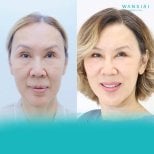 Before and after mini facelift results at Wansiri Hospital, facial rejuvenation and lifting