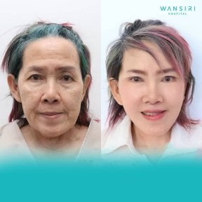Before and after mini facelift results at Wansiri Hospital, facial rejuvenation procedure