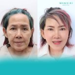 Before and after mini facelift results at Wansiri Hospital, facial rejuvenation procedure