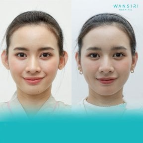 Before and after otoplasty results at Wansiri Hospital, ear reshaping for natural appearance