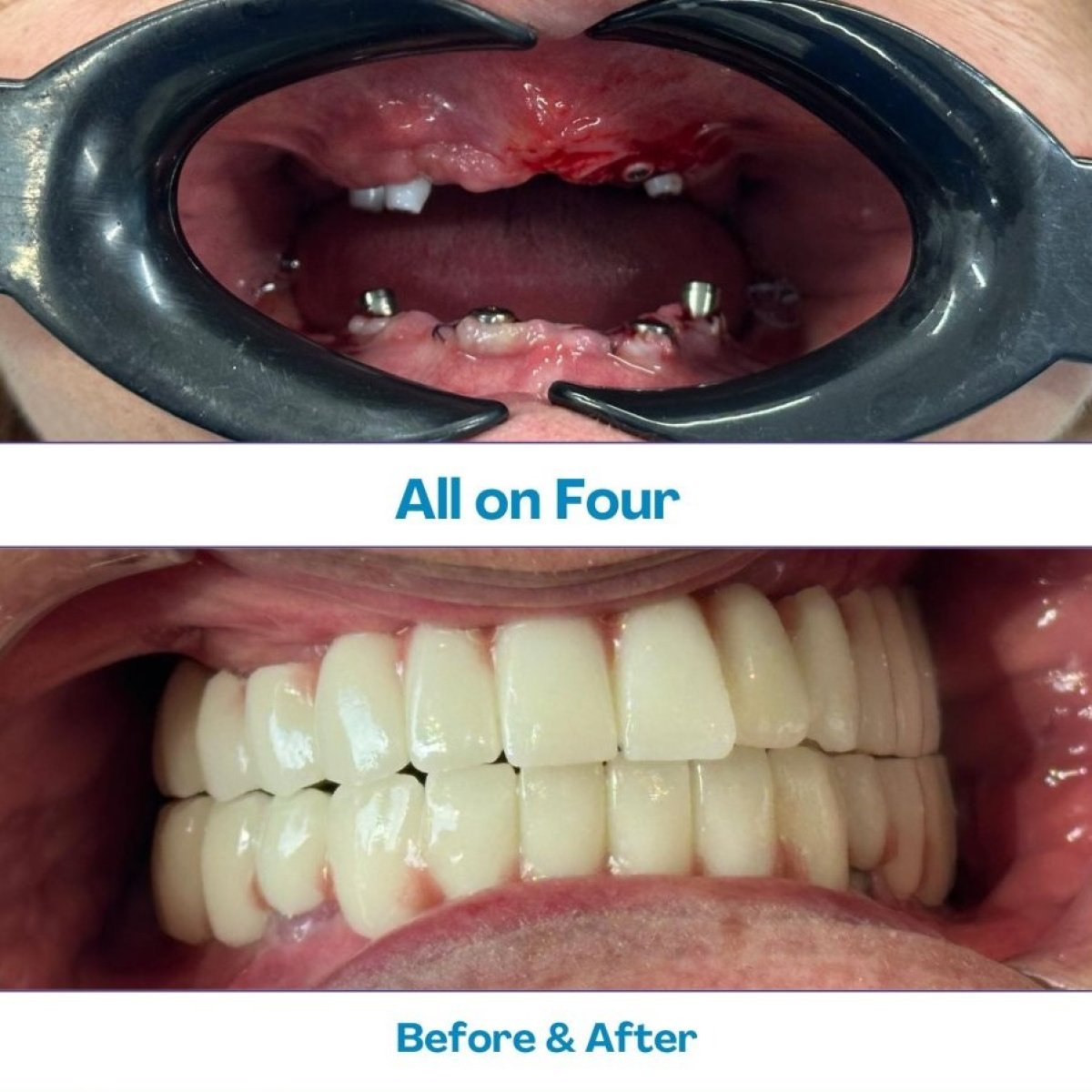 نتيجة قبل وبعد زراعة أسنان زيغوماتيك All-on-4 في مستشفى İstinye Dental