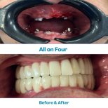 Результат до и после установки зигоматических All-on-4 имплантов в İstinye Dental Hospital