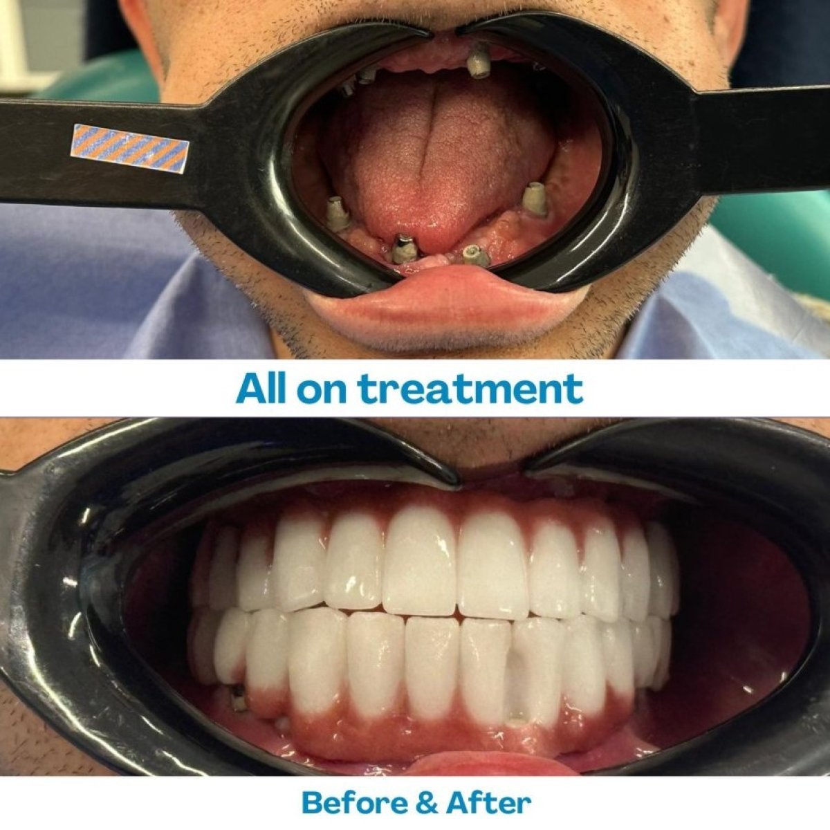 نتيجة زراعة الأسنان زيغوماتيك All-on-4 قبل وبعد في مستشفى İstinye Dental