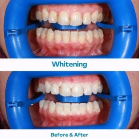 Résultats avant et après du blanchiment des dents à İstinye Dental Hospital, sourire plus éclatant