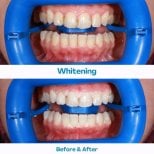 Résultats avant et après du blanchiment des dents à İstinye Dental Hospital, sourire plus éclatant