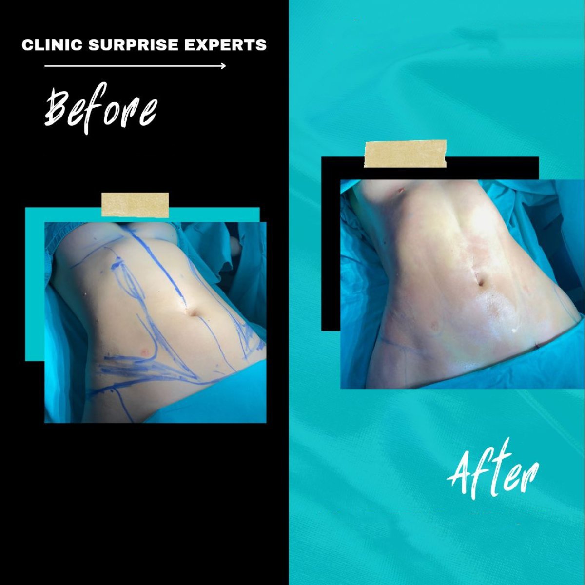 نتائج شفط الدهون قبل وبعد في Surprise Experts Clinic، تحديد واضح للبطن