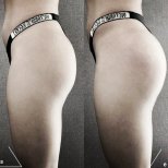 Vorher-nachher-Ergebnisse Brazilian Butt Lift bei Surprise Experts Clinic, verbesserte Kontur