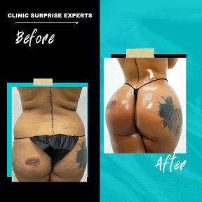 Vorher-nachher-Ergebnis Brazilian Butt Lift bei Surprise Experts Clinic, sichtbare Kurven
