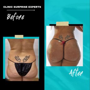 Vorher-nachher-Ergebnis Brazilian Butt Lift bei Surprise Experts Clinic, verbesserte Kontur