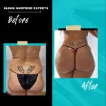 Vorher-nachher-Ergebnis Brazilian Butt Lift bei Surprise Experts Clinic, verbesserte Kontur